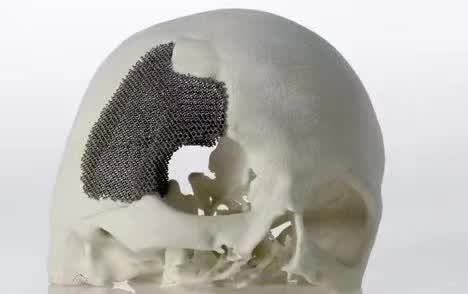 顱骨3D打印技術(shù)是什么？